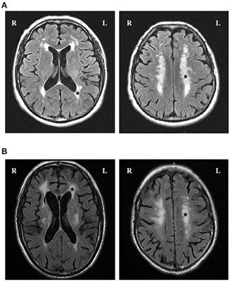 Association of Trimethylamine N-Oxide and Its Precursor With Cerebral Small Vessel Imaging Markers